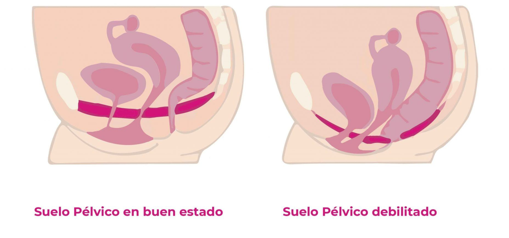 suelo_pélvio_normal_vs_debilitado.PNG