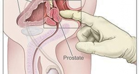 Comment trouver la prostate ?